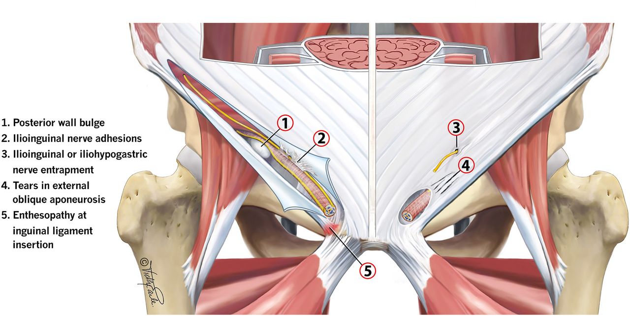 بیماری پوبالژیای شکمی یا فتق ورزشی