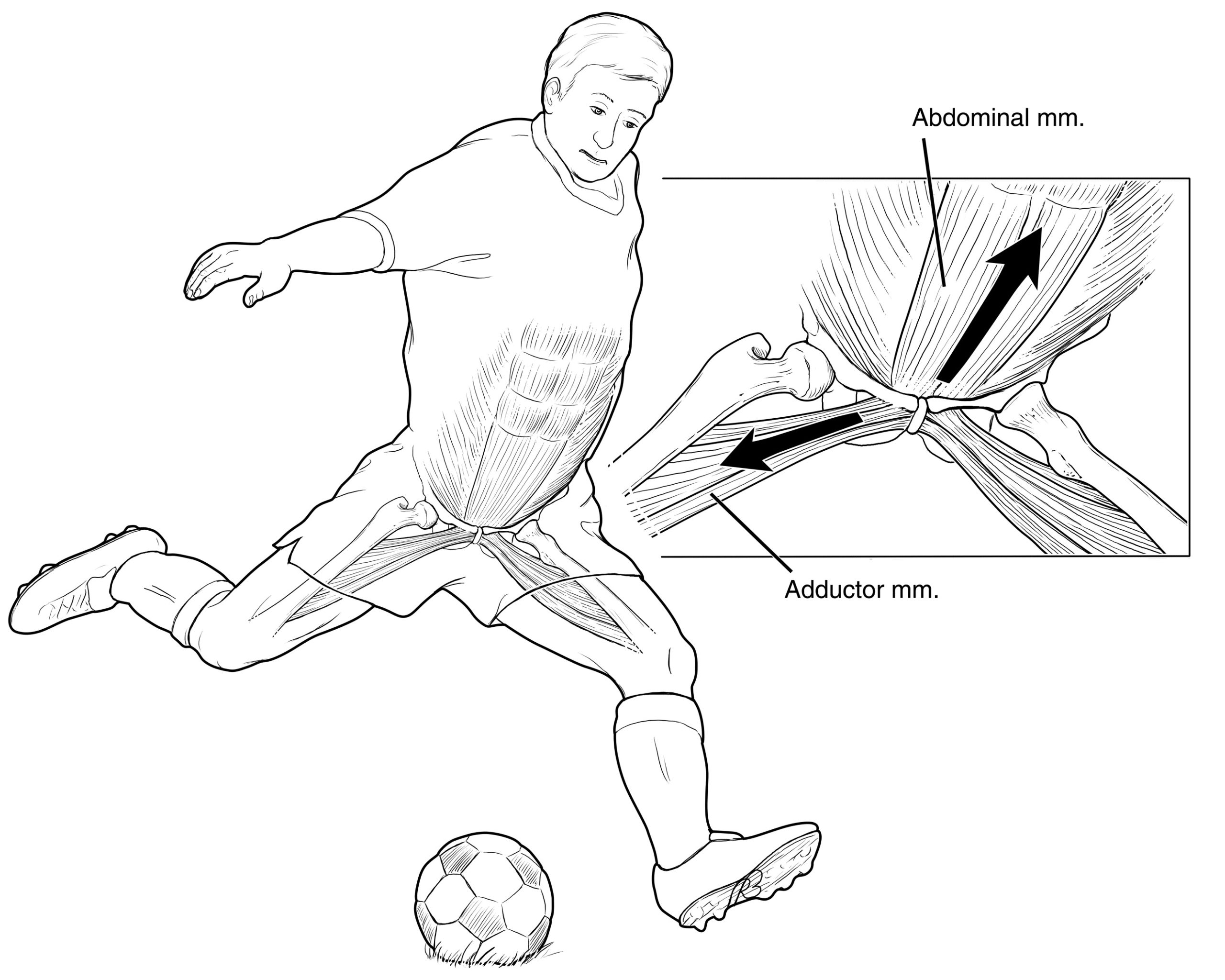 بیماری پوبالژیا یا فتق ورزشی